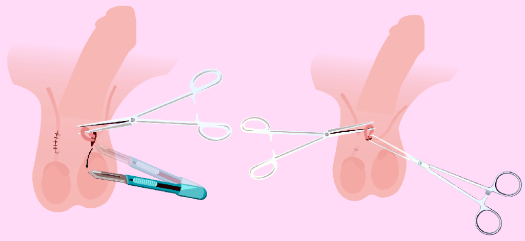 Vazektomia (sterilizimi mashkullor) Vazektomia (sterilizimi mashkullor)